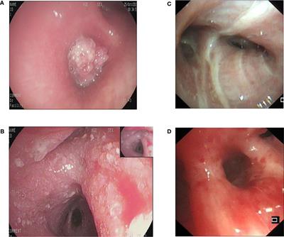 The investigation of construction and clinical application of image recognition technology assisted bronchoscopy diagnostic model of lung cancer